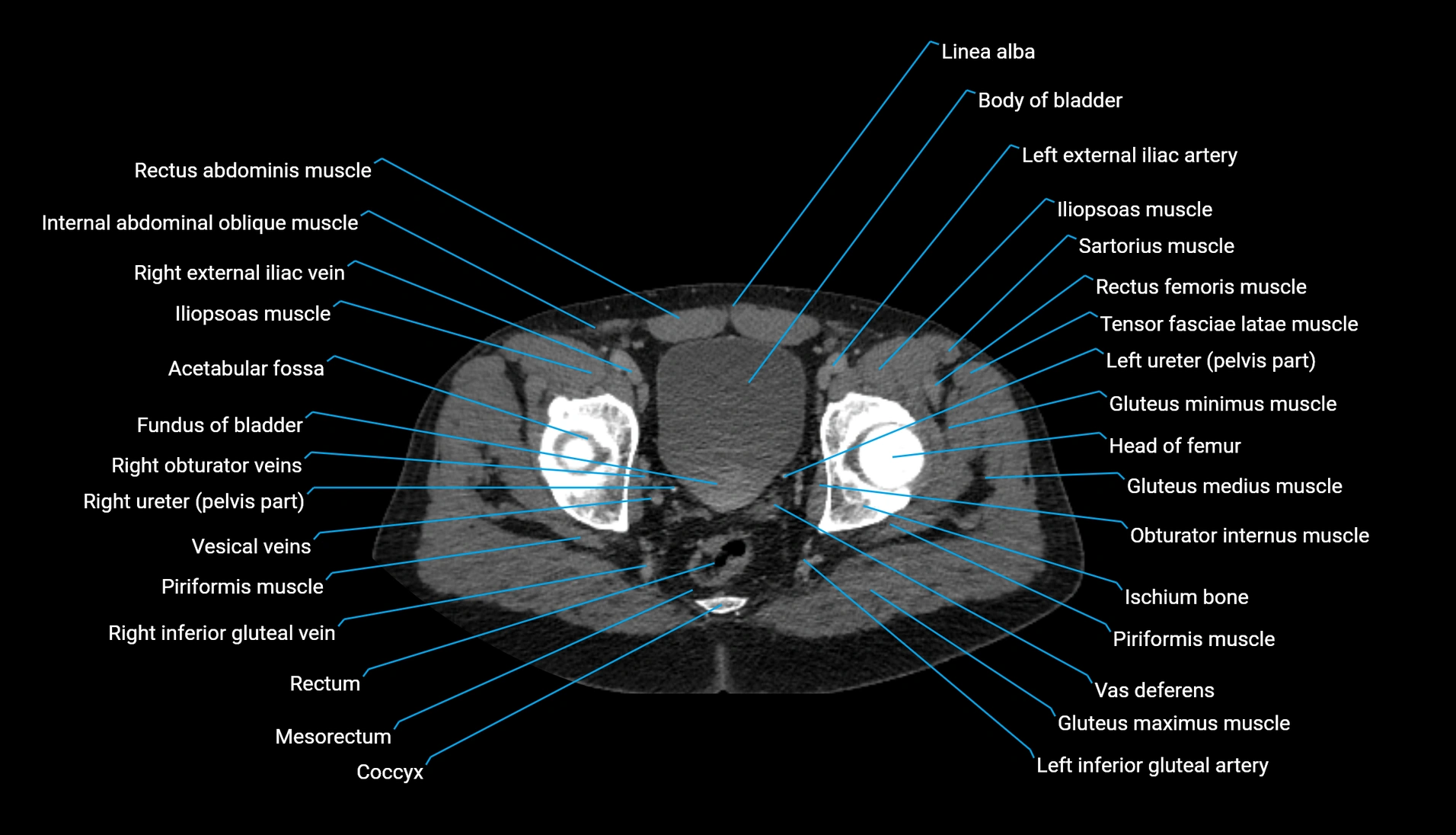 CT urogram axial cross sectional anatomy  labelled radiology image-00225.webp
